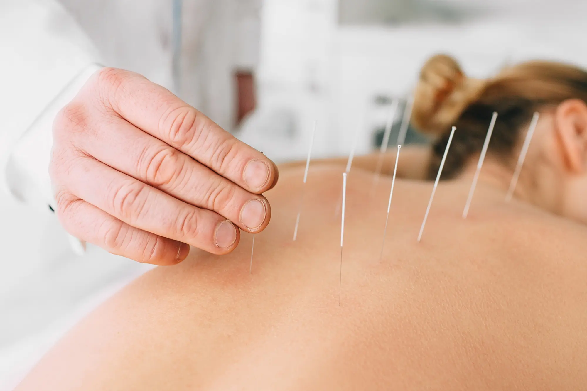 dry needling Melbourne